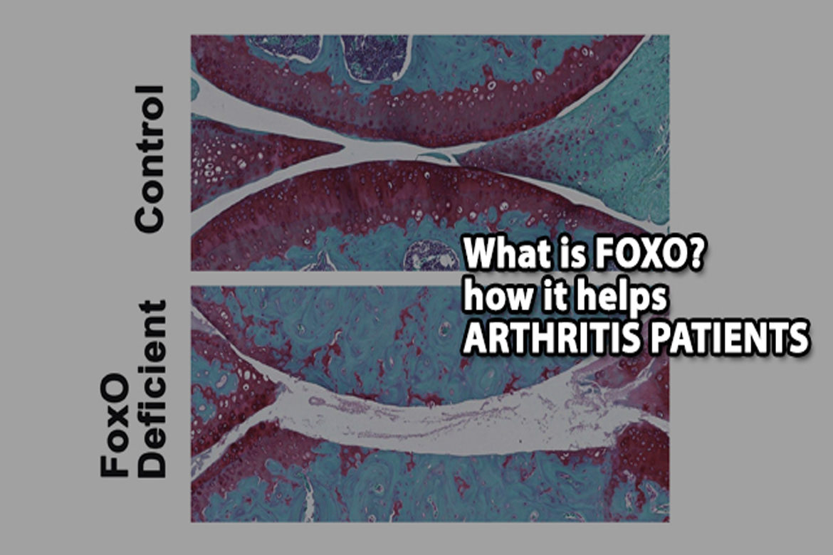 2 What is FOXO? how it helps arthritis patients