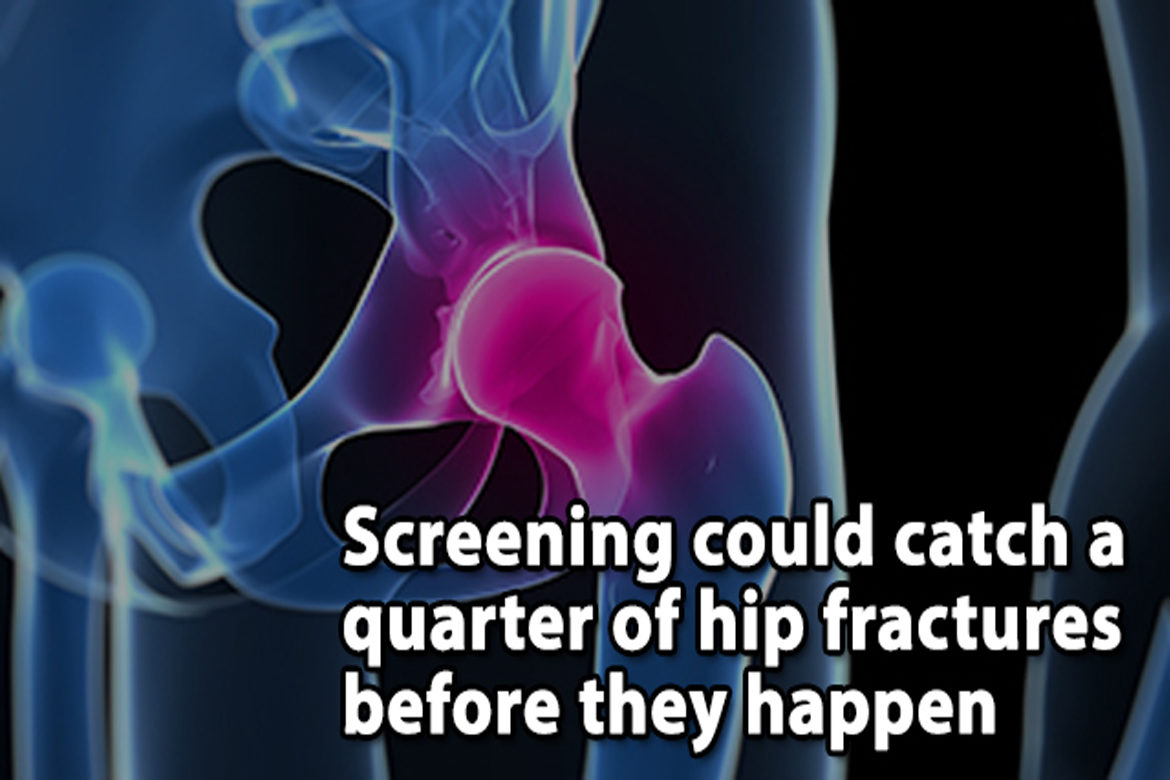 Screening_could_catch_a_quarter_of_hip_fractures_before_they_happen_happy_hospitals Screening could catch a quarter of hip fractures before they happen