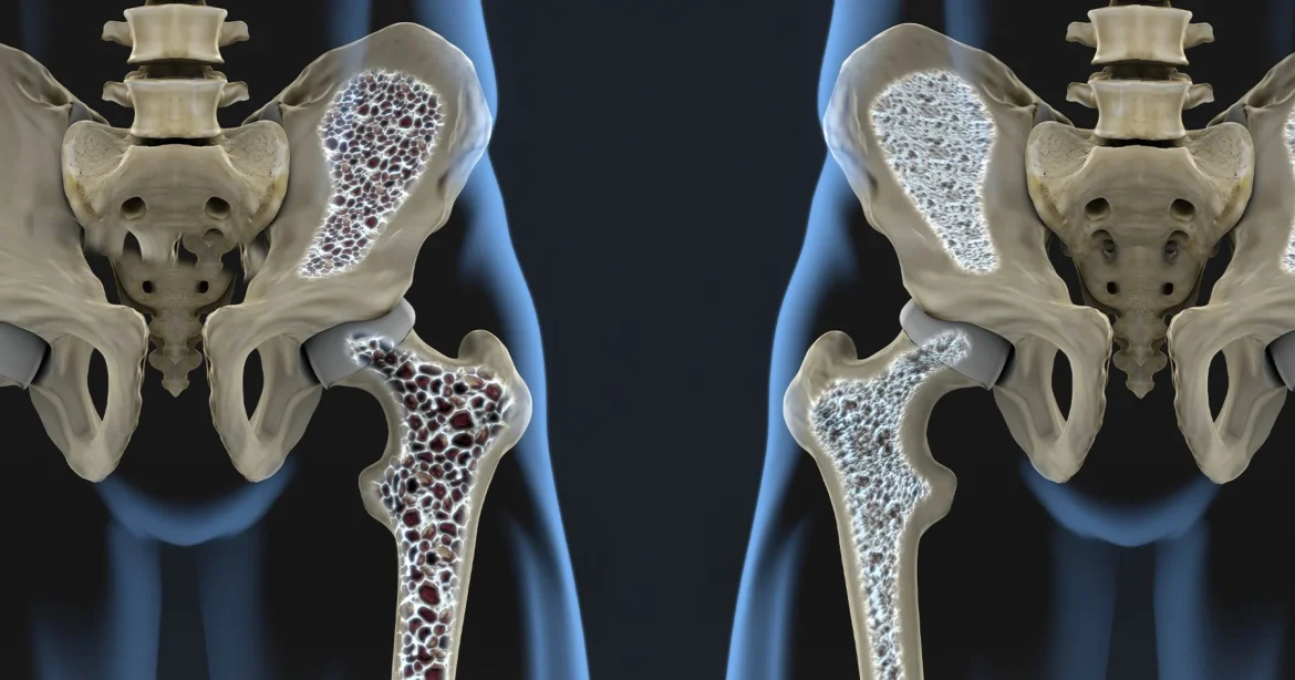 Bone density in female vs male explained by top orthopedic doctor in India