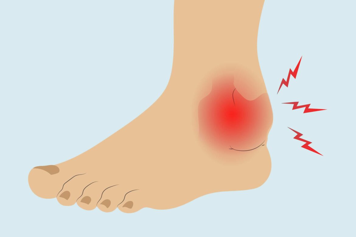 0519_Arthritis-in-Ankle Arthritis of Foot and Ankle: Understanding, Symptoms, and Management
