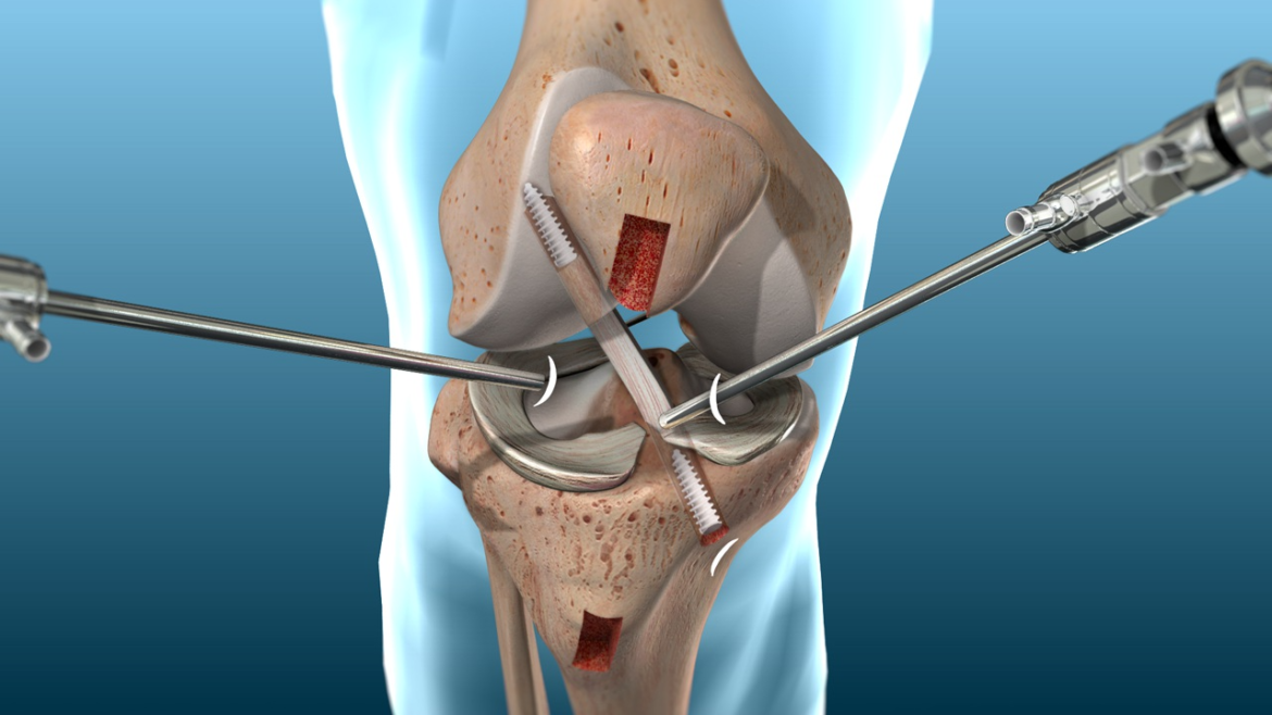 acl_1280 How does ACL Reconstruction Surgery Work?