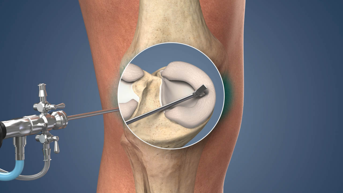 Arthroscopic Meniscus Repair Recovery Time Arthroscopic Meniscus Repair Recovery Time