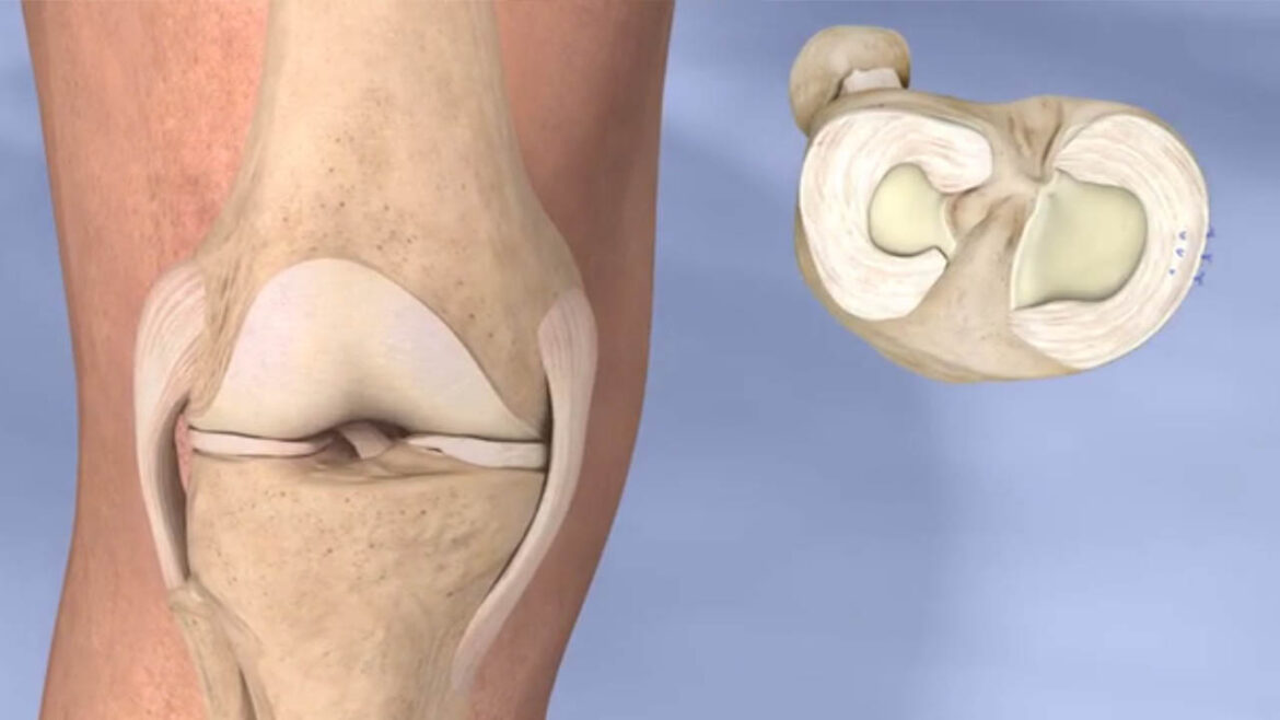 Arthroscopic meniscus repair success rate explained Arthroscopic meniscus repair
