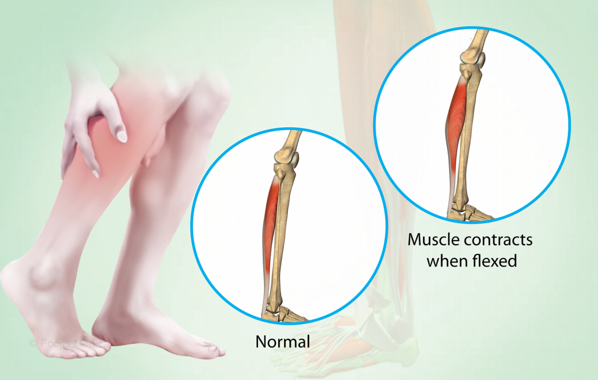 Charley Horse Symptoms, Causes and Risk Factors