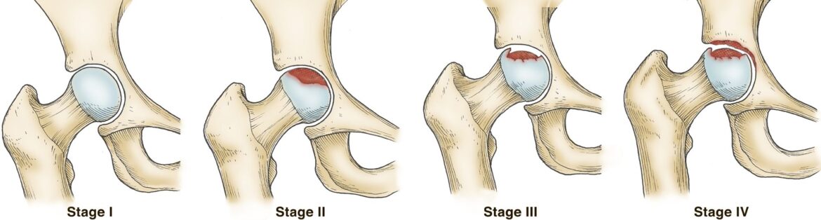 Stages of AVN or Avascular Necrosis Explained Stages of AVN or Avascular Necrosis Explained