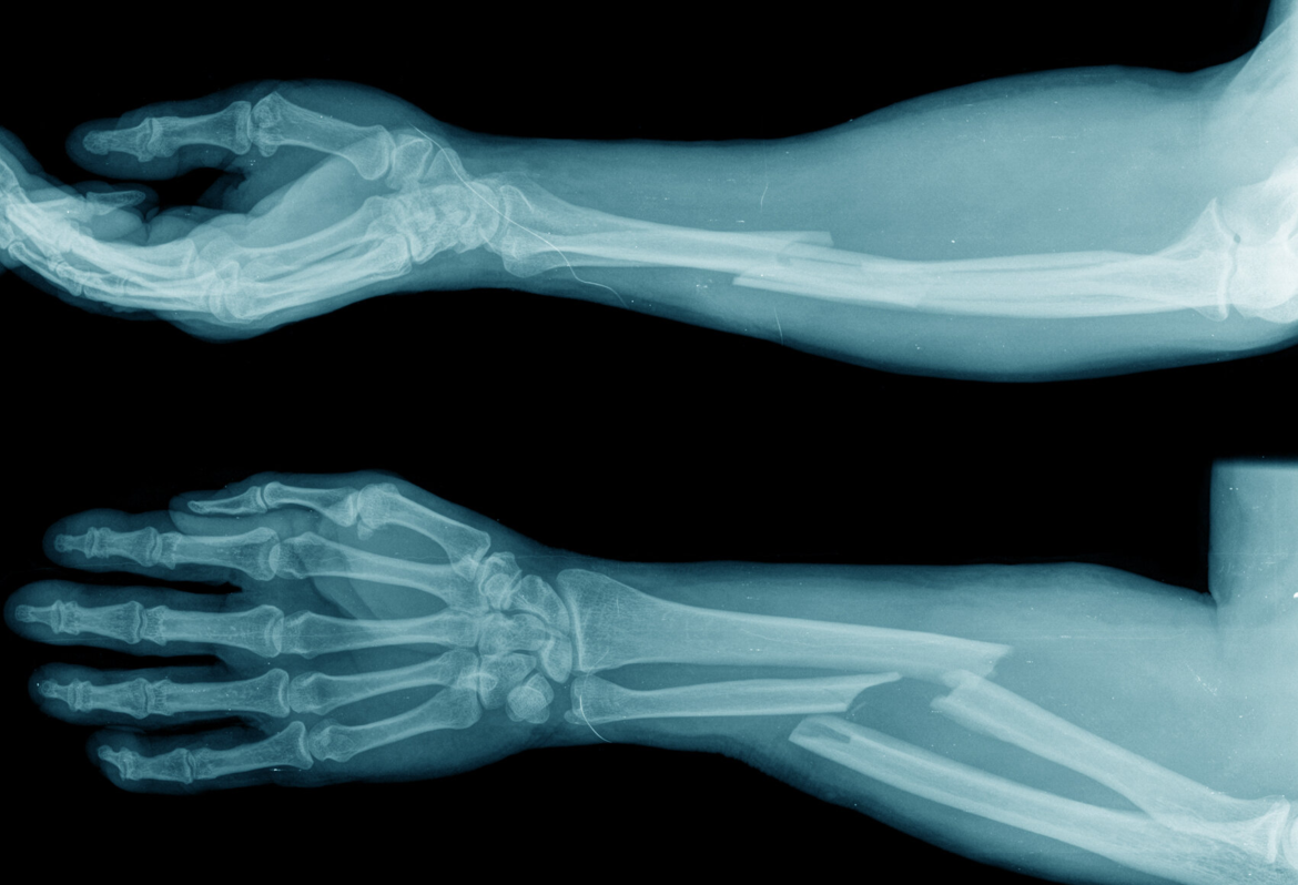 When Does a Fracture Require Surgery Fracture Surgery