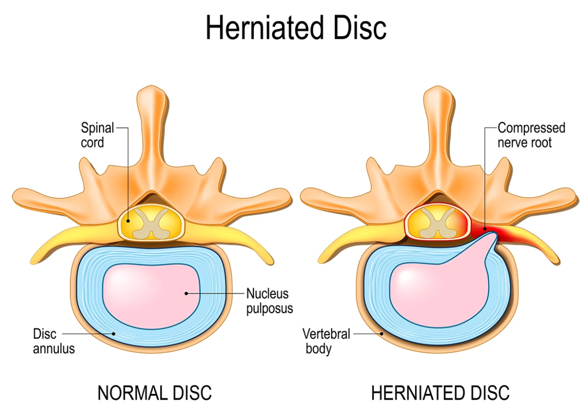 herniated-disc What Does a Herniated Disc Feel Like? Symptoms, Causes, and Treatment