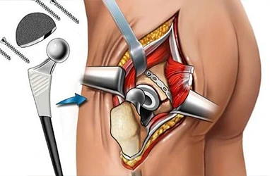 Best Hip Replacement Surgeon in Andhra Pradesh