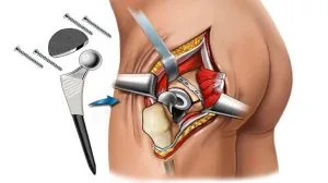 Partial Hip Replacement Surgery