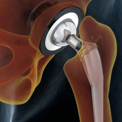 Best Joint Replacement Surgeon in Guntur