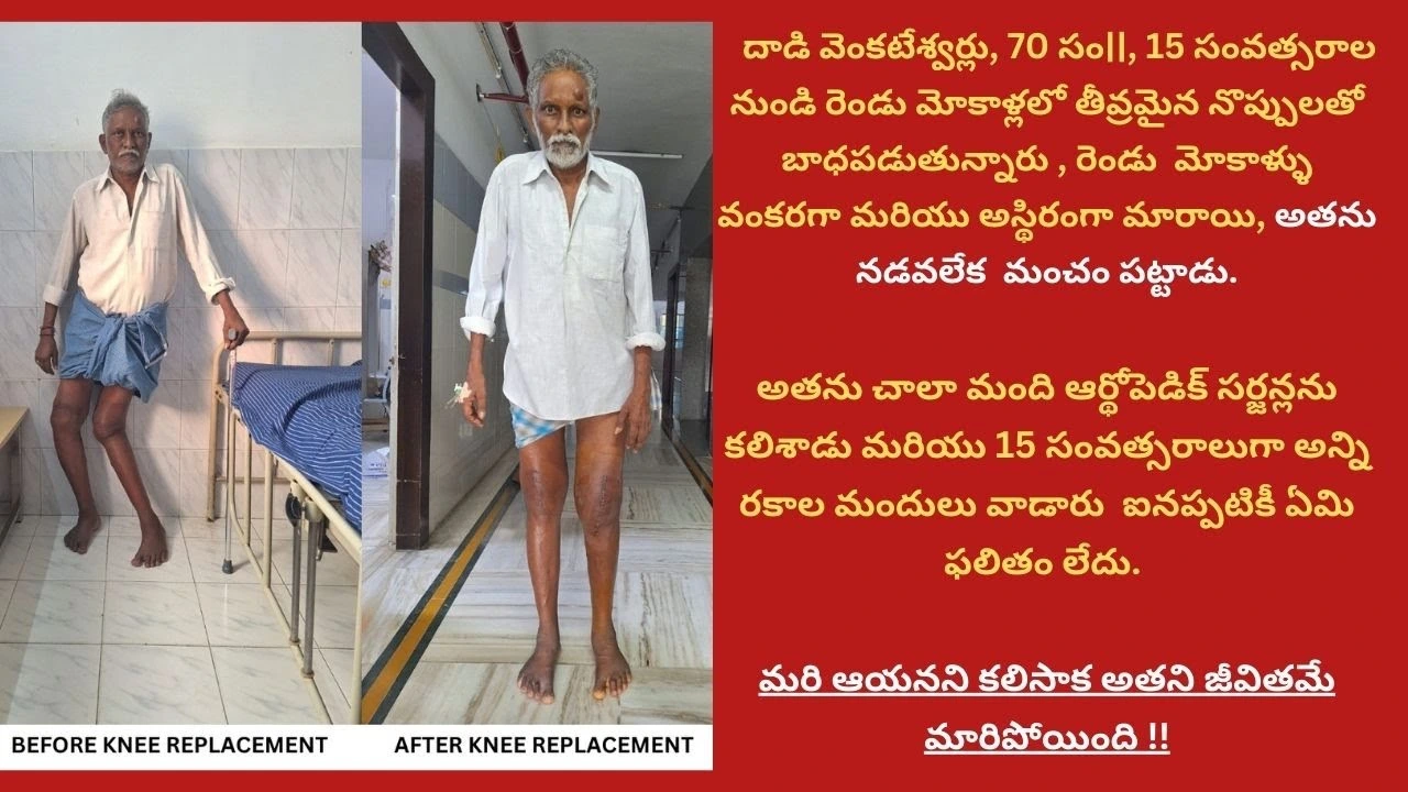 Complex Knee Replacement, Wind Swipe Deformity Success Story