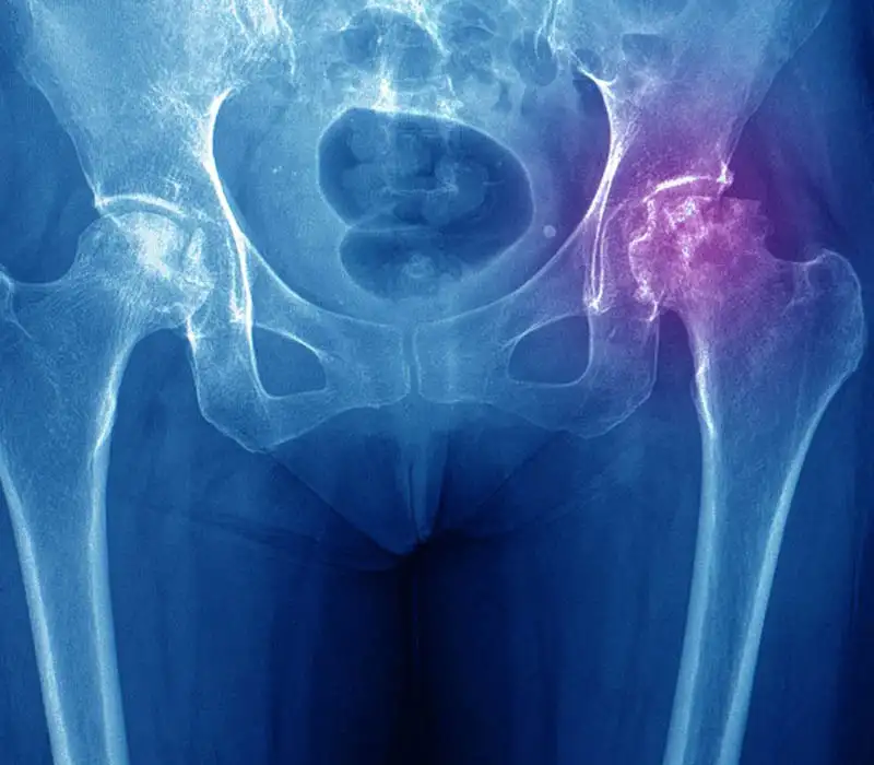 AVN Of Hip