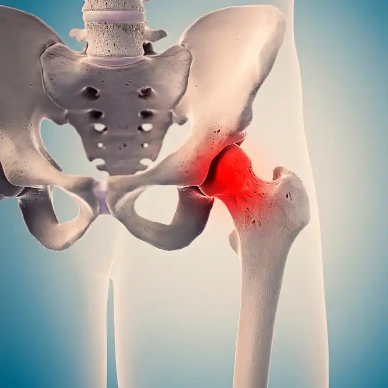Best AVN of hip treatment in Guntur