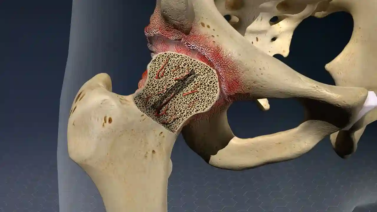 Best AVN of hip treatment in Guntur