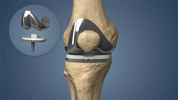 Best Knee Surgeon in Andhra Pradesh