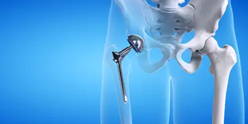 Partial Hip Replacement