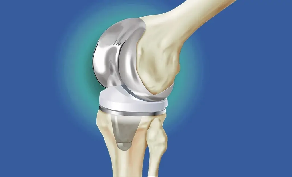 Full Knee replacement surgeon in andhra pradesh