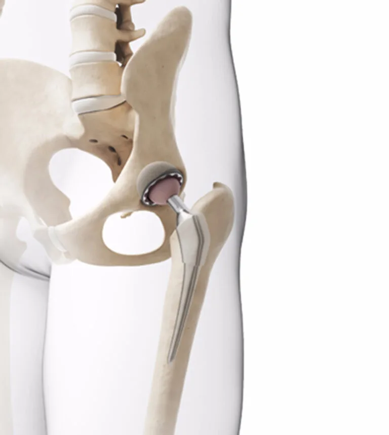 Full Hip Replacement