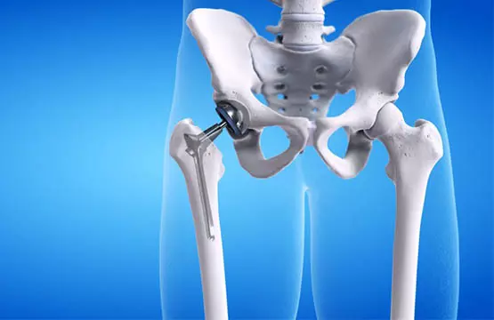 Best Hip Replacement Hospital In India