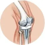 Knee replacement surgery from the best orthopaedic hospital, Andhra Pradesh