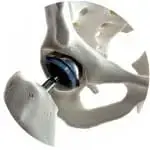 Hip replacement surgery by top orthopaedic surgeon, Andhra Pradesh