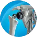This Surgery aims to relieve pain, restore range of motion , Andhra Pradesh